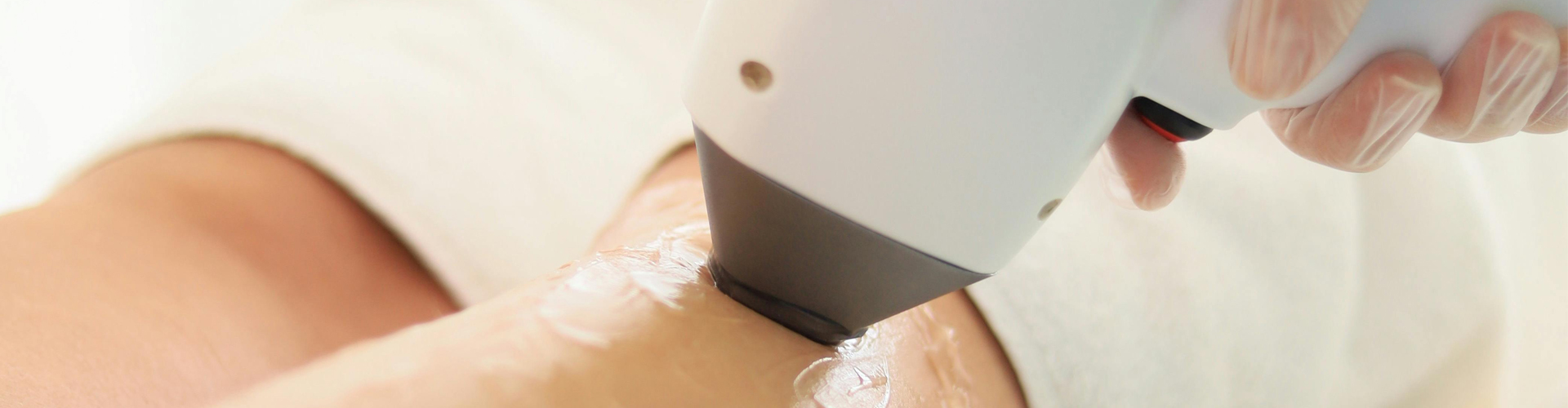 epilazione laser